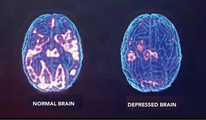 Depression, OCD, Pain &CRPS Reversed.webp
